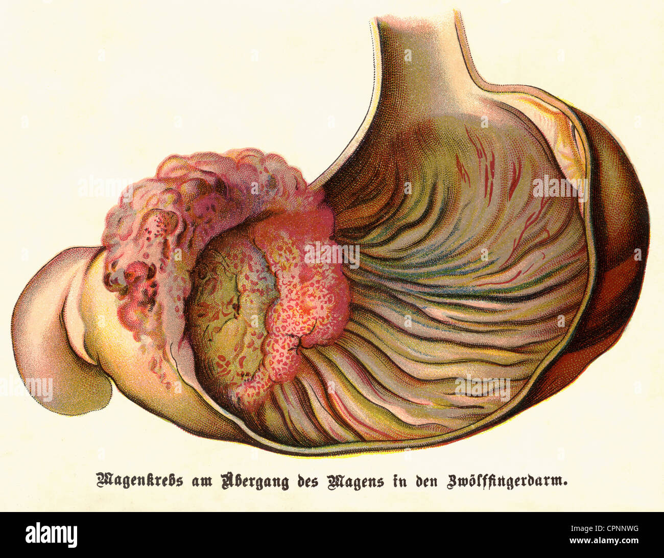 Medizin, Krankheiten, Krebs, Magenkrebs zwischen Magen und Zwölffingerdarm, Lithographie, Deutschland, um 1900, Zusatzrechte-Clearences-nicht vorhanden Stockfoto