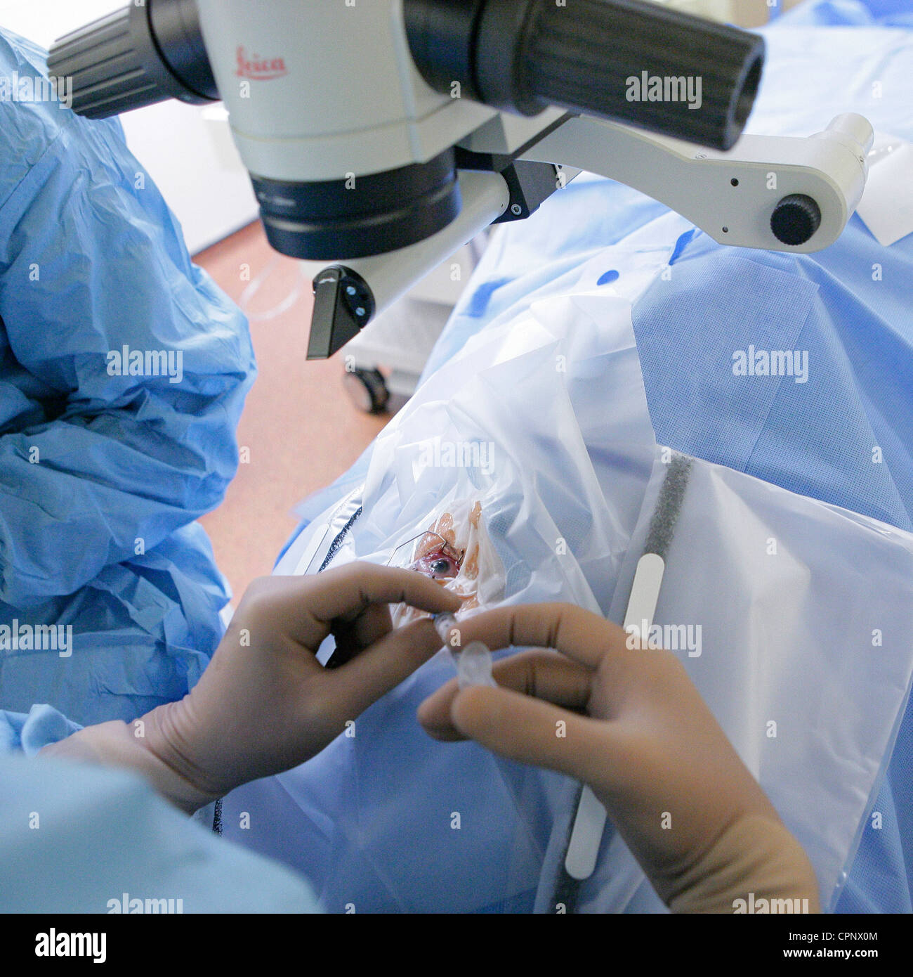 KATARAKT CHIRURGIE Stockfoto