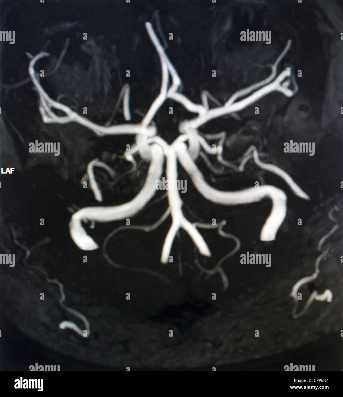 ZEREBRALEN ARTERIE MRA Stockfoto