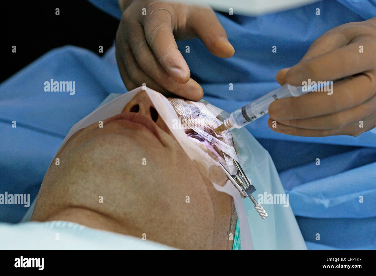 LASER-AUGENCHIRURGIE Stockfoto