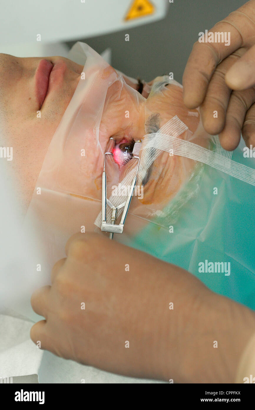 LASER-AUGENCHIRURGIE Stockfoto