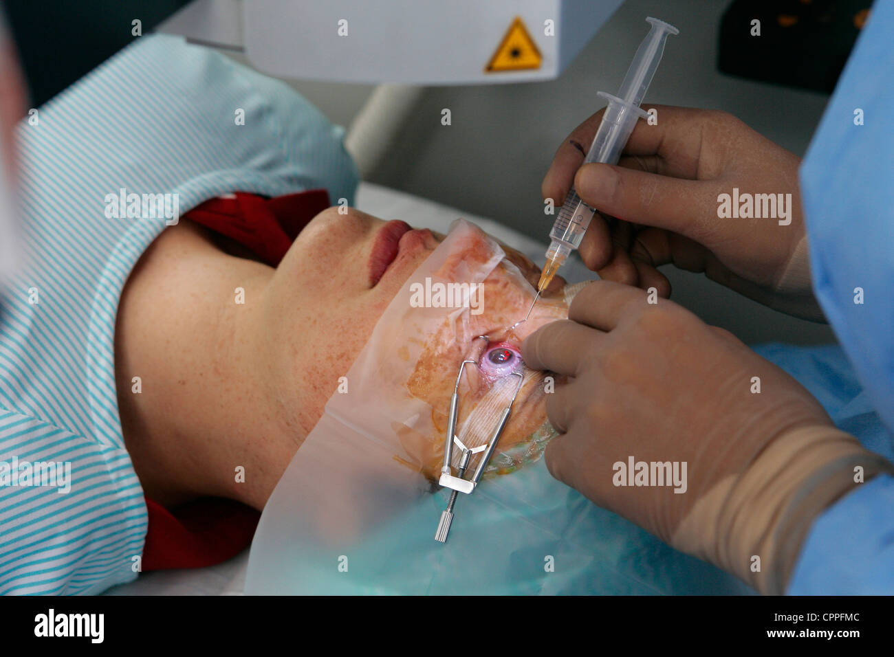 LASER-AUGENCHIRURGIE Stockfoto