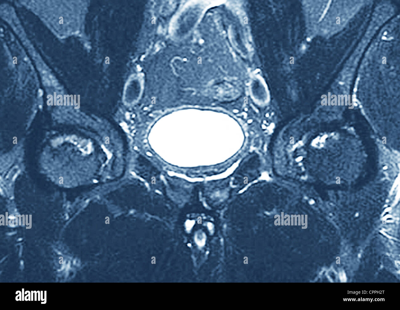OSTEONEKROSE DES HÜFTGELENKS Stockfoto