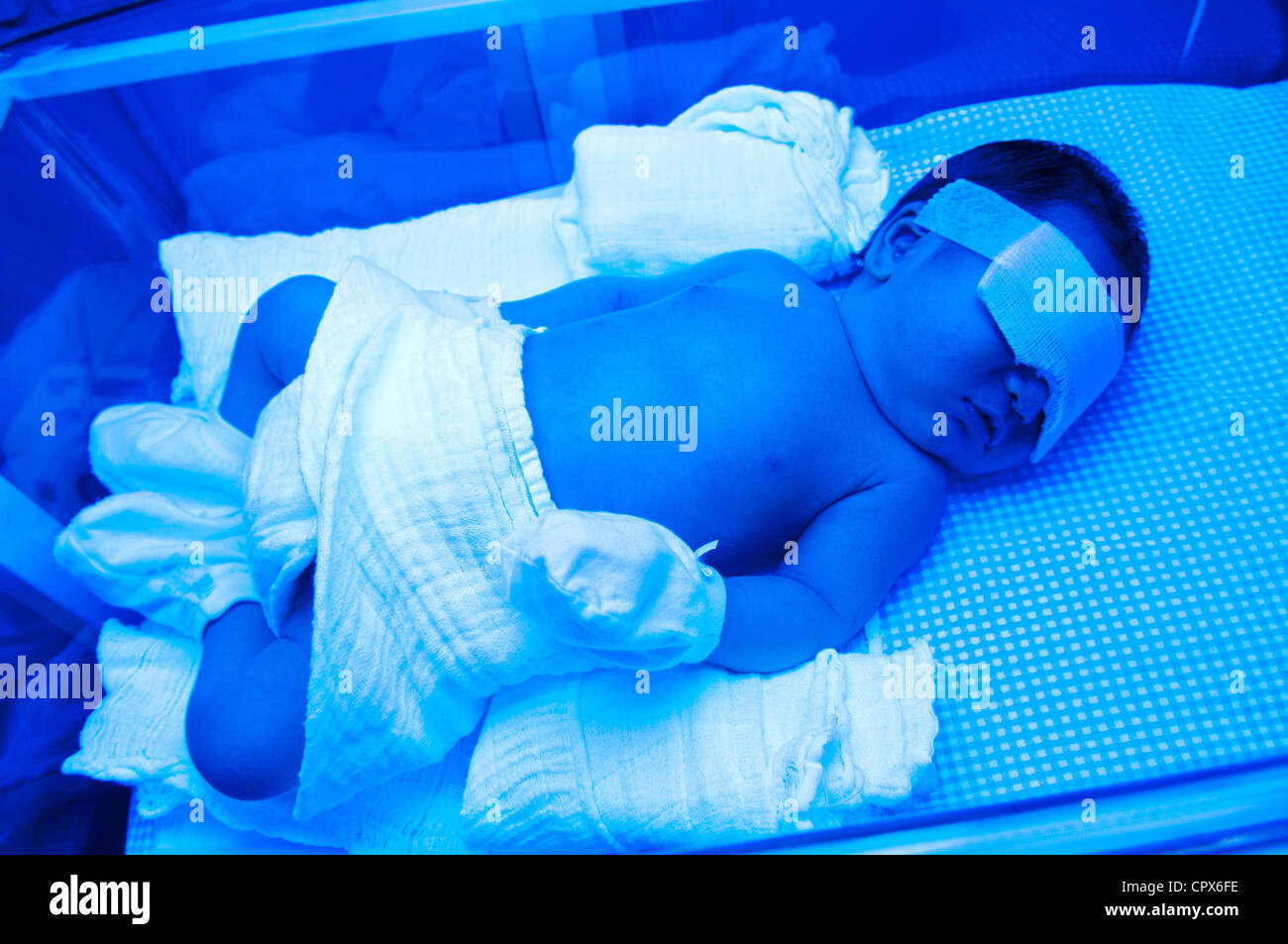 Neugeborenes Baby mit Gelbsucht unter UV-Licht im Inkubator Stockfoto
