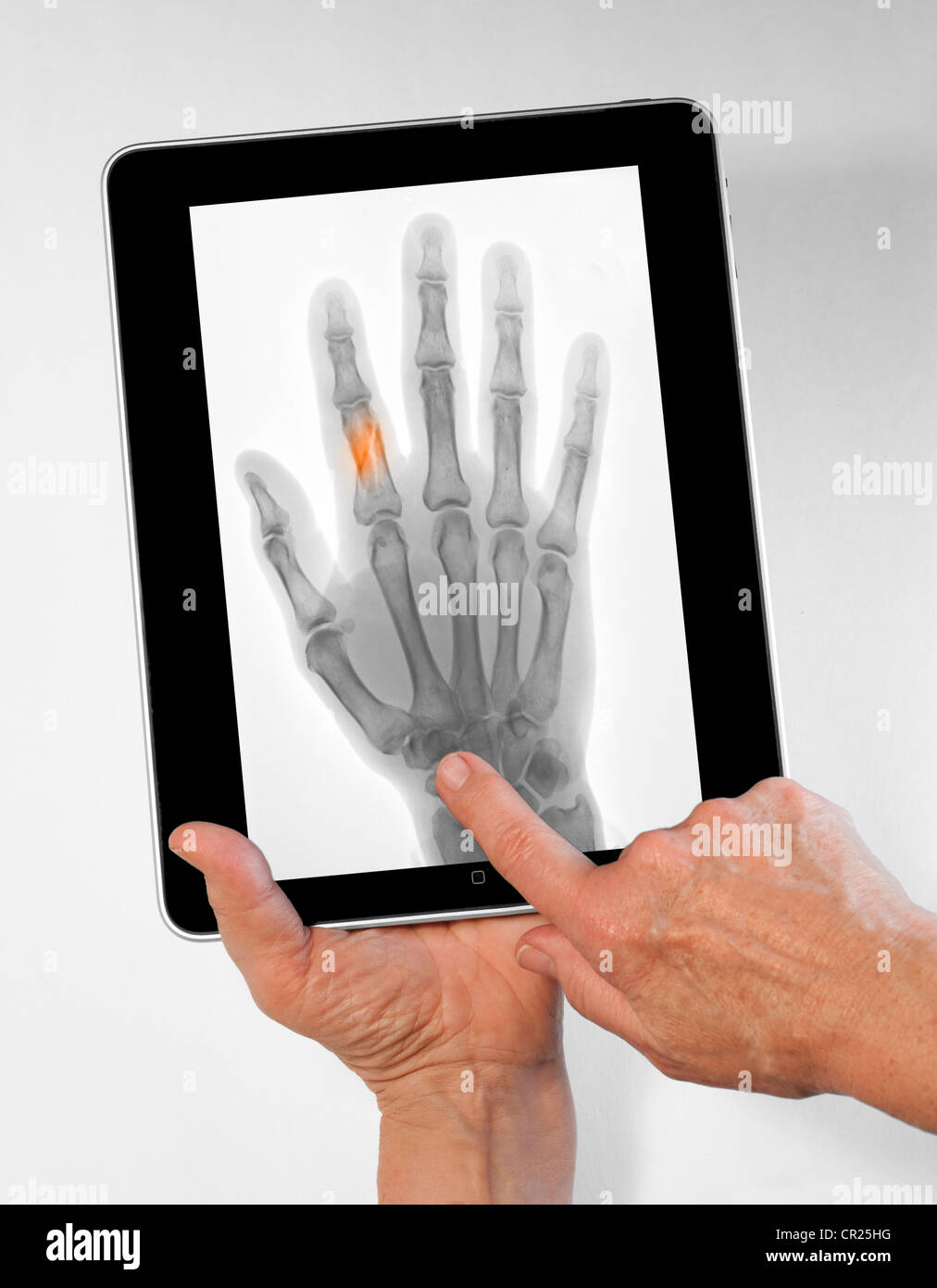iPad zeigt ein Röntgenbild von einem gebrochenen finger Stockfotografie