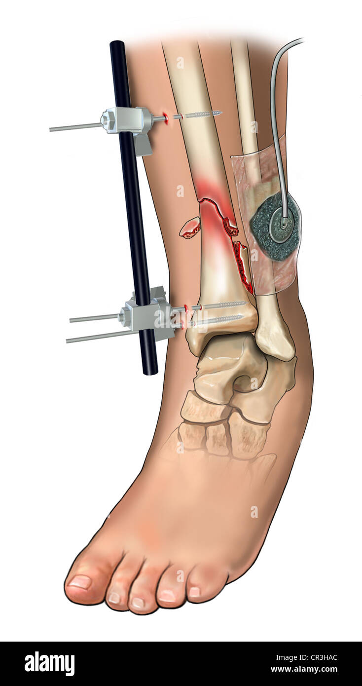 Left Tibia Fixation Externe Fixation der Tibia Stockfotografie - Alamy