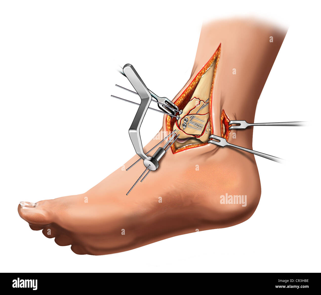 Mediale Malleolar Frakturfixation Stockfotografie Alamy