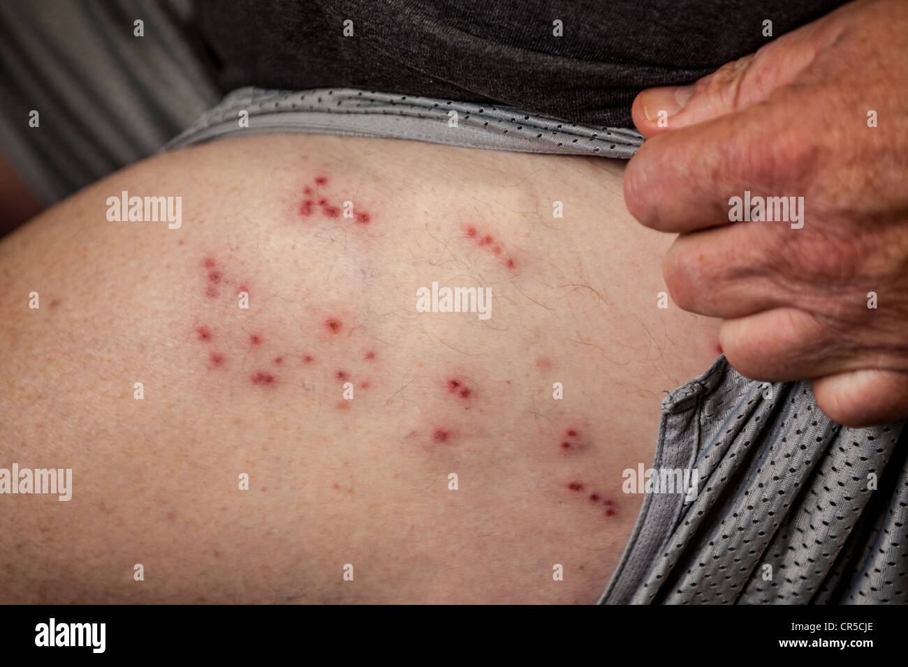 Herpes Zoster Stockfotos & Herpes Zoster Bilder - Alamy