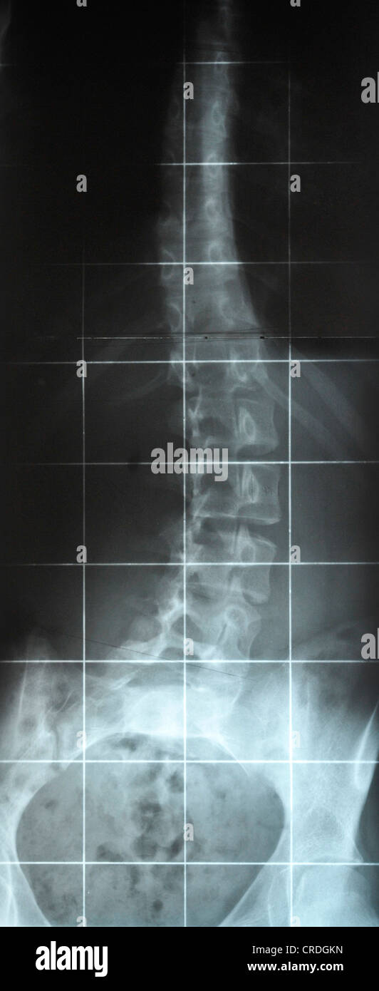 Röntgenbild einer gekrümmten Wirbelsäule aufgrund von Skoliose Stockfoto