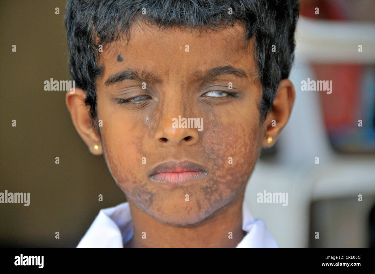 Mädchen, geblendet durch eine Infektion, Schule für Blinde, Tangalle, Sri Lanka, Ceylon, Südasien, Asien Stockfoto