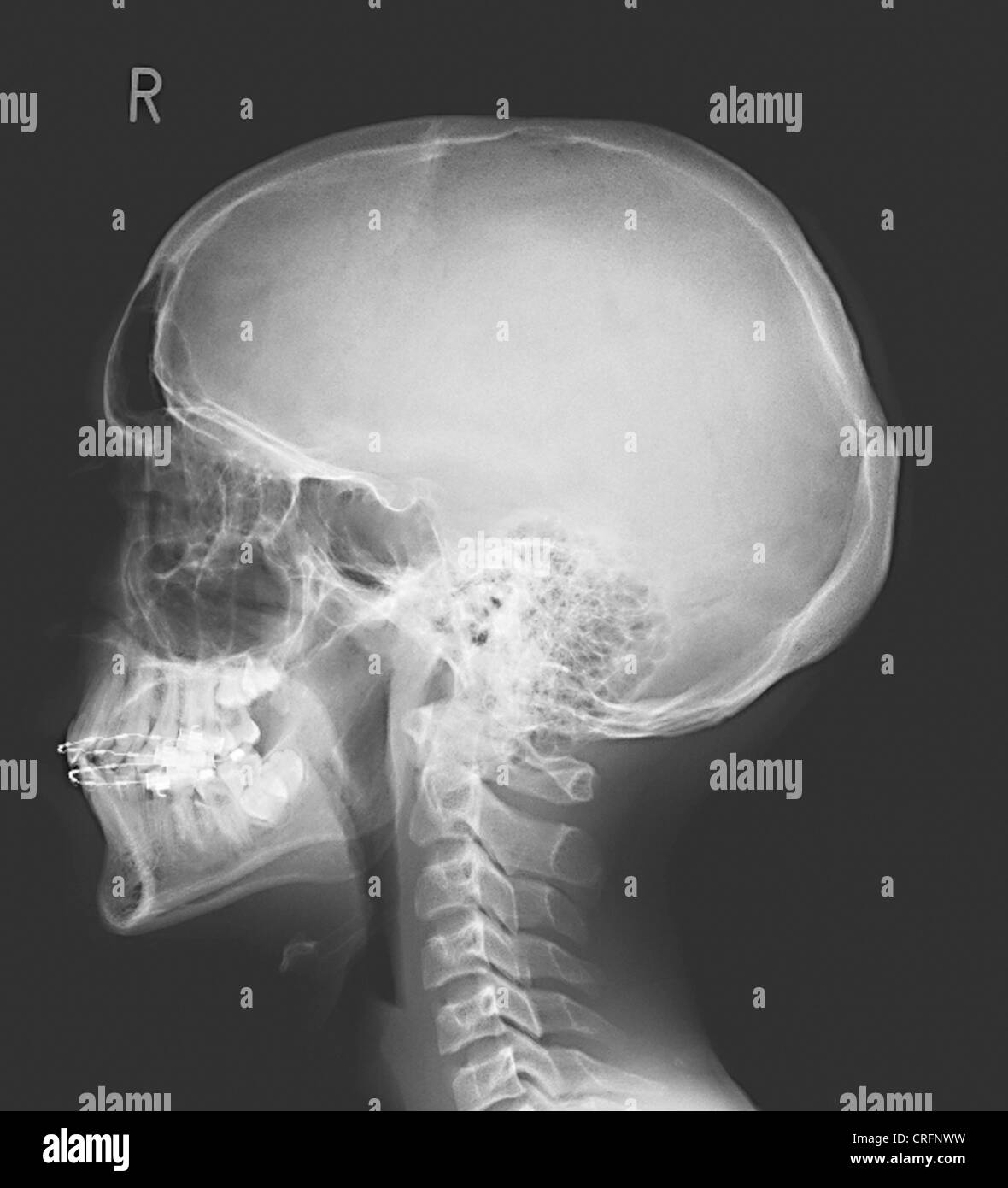 Menschen, Menschen, Menschen (Homo Sapiens sapiens), Röntgenaufnahme des Schädels Stockfoto