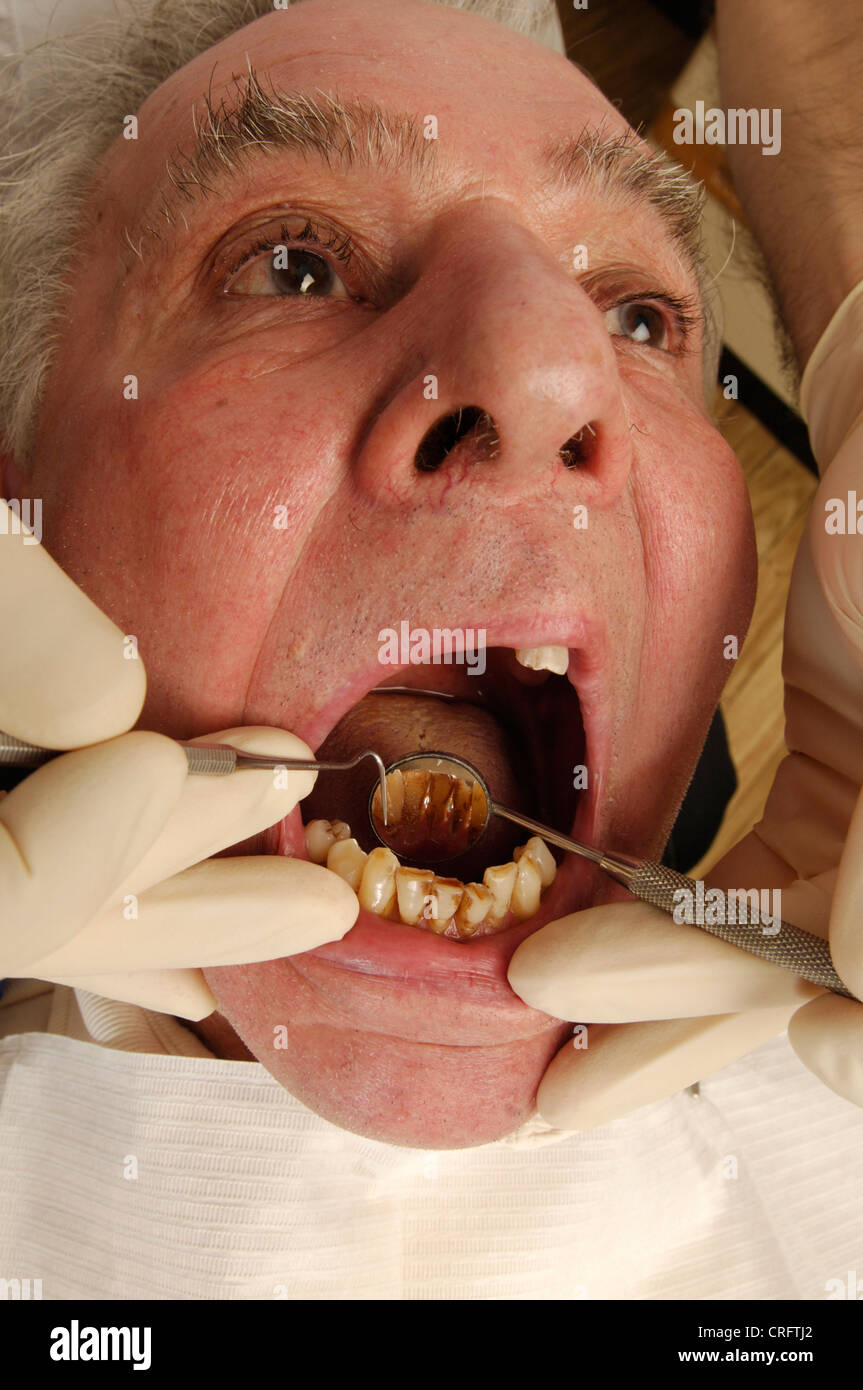Ein Zahnarzt untersucht den Zustand eines älteren Mannes Zähne mit einem dental Pick und abgewinkelten Spiegel. Stockfoto