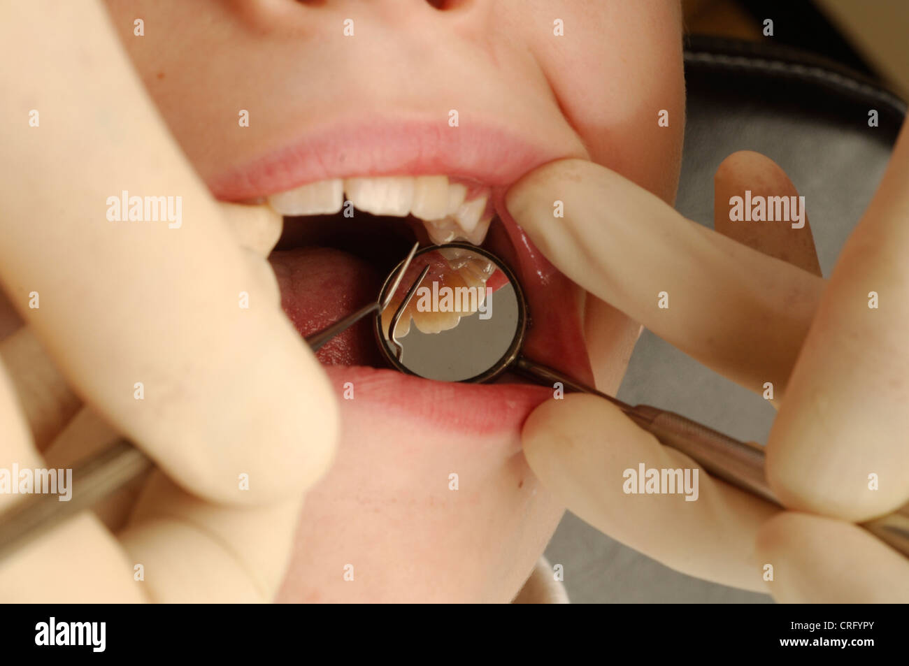 Eine Spiegelung in einen jungen Mund vom Zahnarzt geprüft wird. Stockfoto