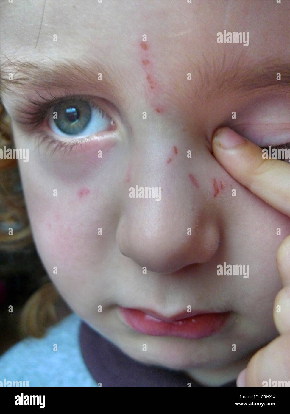 kleine traurige junge mit Narben im Gesicht kratzen Stockfoto