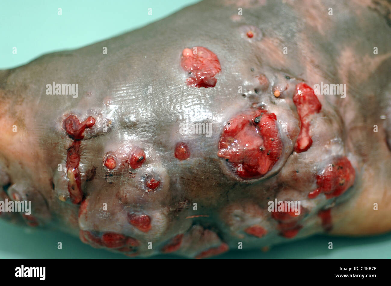 Erweiterten Fuß aufgrund Myzetom Myzetom ist eine seltene Krankheit, die in den Tropen gefunden. Es ist eine chronische, lokalisierte Infektion der Haut und zugrunde liegende Gewebe gekennzeichnet durch die Bildung von mehrere Abszesse (Sammlungen von Eiter) und Granulome (Sammlungen von Epitheloid Histiocyte Zellen in eine immunologische Reaktion auf den Erreger produziert). Diese Stockfoto