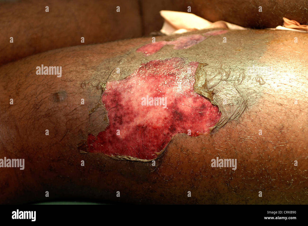 Nahaufnahme von einer Sepsis Ischämie Oberschenkel. Ischämie ist die eingeschränkte Blutversorgung zu einem Bereich des Körpers, durch die Verengung der Blutgefäße verursacht. In diesem Fall hat Ischämie verursacht den Tod von Gewebe und Infektion. Stockfoto