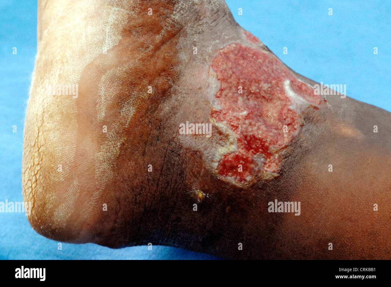 Venösen Ulcus am Knöchel von einem älteren Mann. Ein Geschwür ist die offene Wunde auf der Haut, die versagt hat, zu heilen. Das venöse Ulcus verursacht wurde durch die eingeschränkte Sauerstoffversorgung der Haut am Bein, verursacht durch TVT (Tiefe Venenthrombose). Stockfoto
