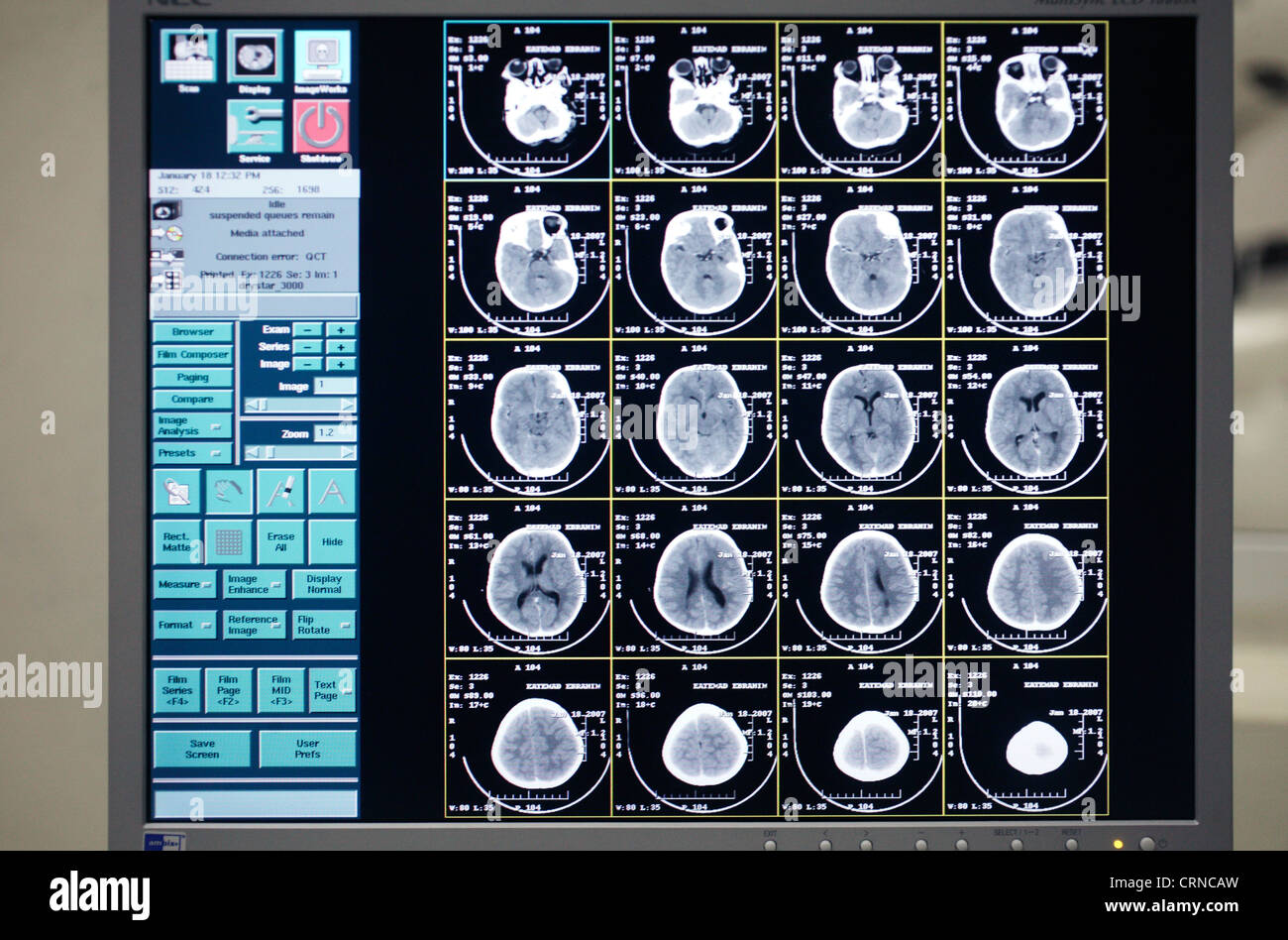 Am Bild von einer CT-Gehirn-Scan ein 5 Jahre altes Kind leidet an Mukoviszidose. Stockfoto