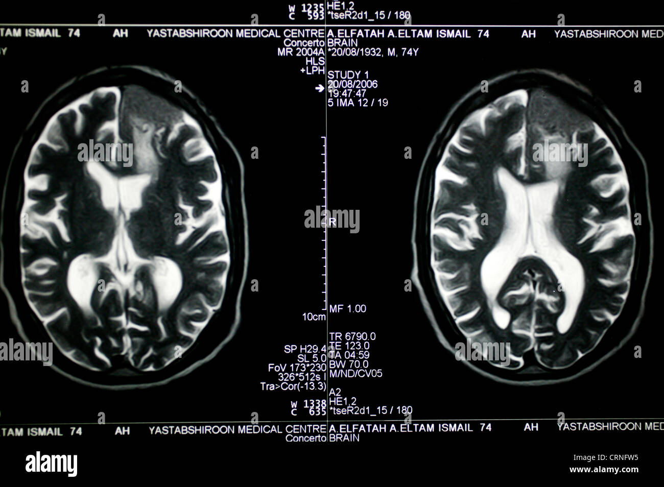 MRT des Gehirns des Patienten. Stockfoto