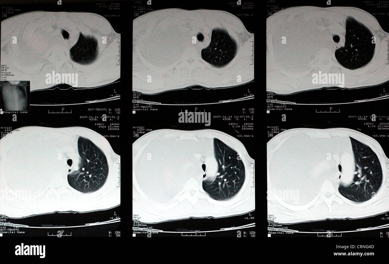 Ein CT-Scan zeigt einen schweren Haemothroax auf der rechten Seite der Brust des Patienten. Stockfoto