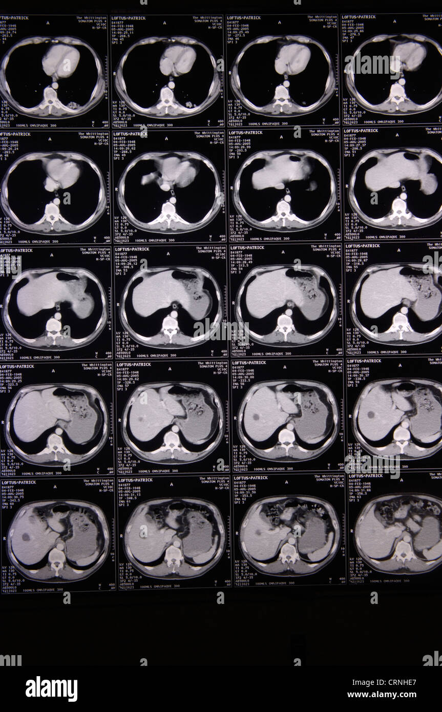 Die MRI Scans gemacht auf der Großhirnrinde. Stockfoto