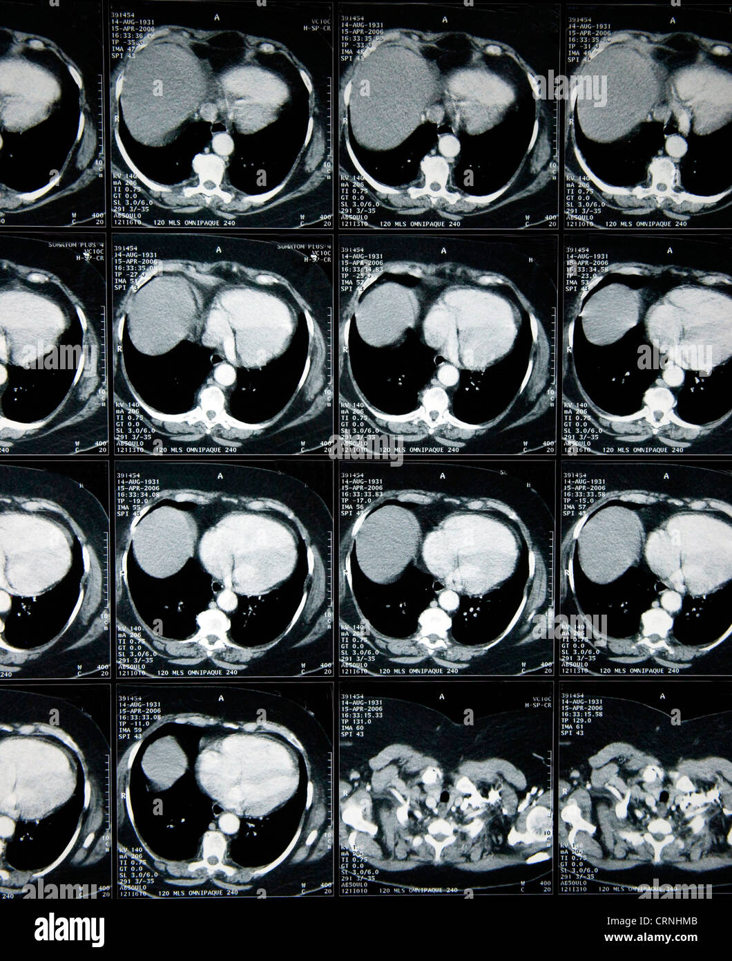 Eine Reihe von x-ray Röntgenbilder auf eine beleuchtete Lichtkasten. Stockfoto