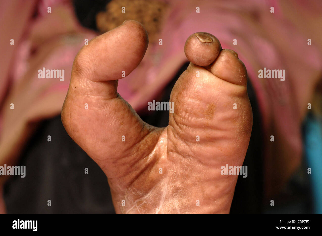 Nahaufnahme des linken Fußes eine 32-jährige Frau mit amputierten mittleren Zehen durch wiederkehrende Myzetom. Stockfoto