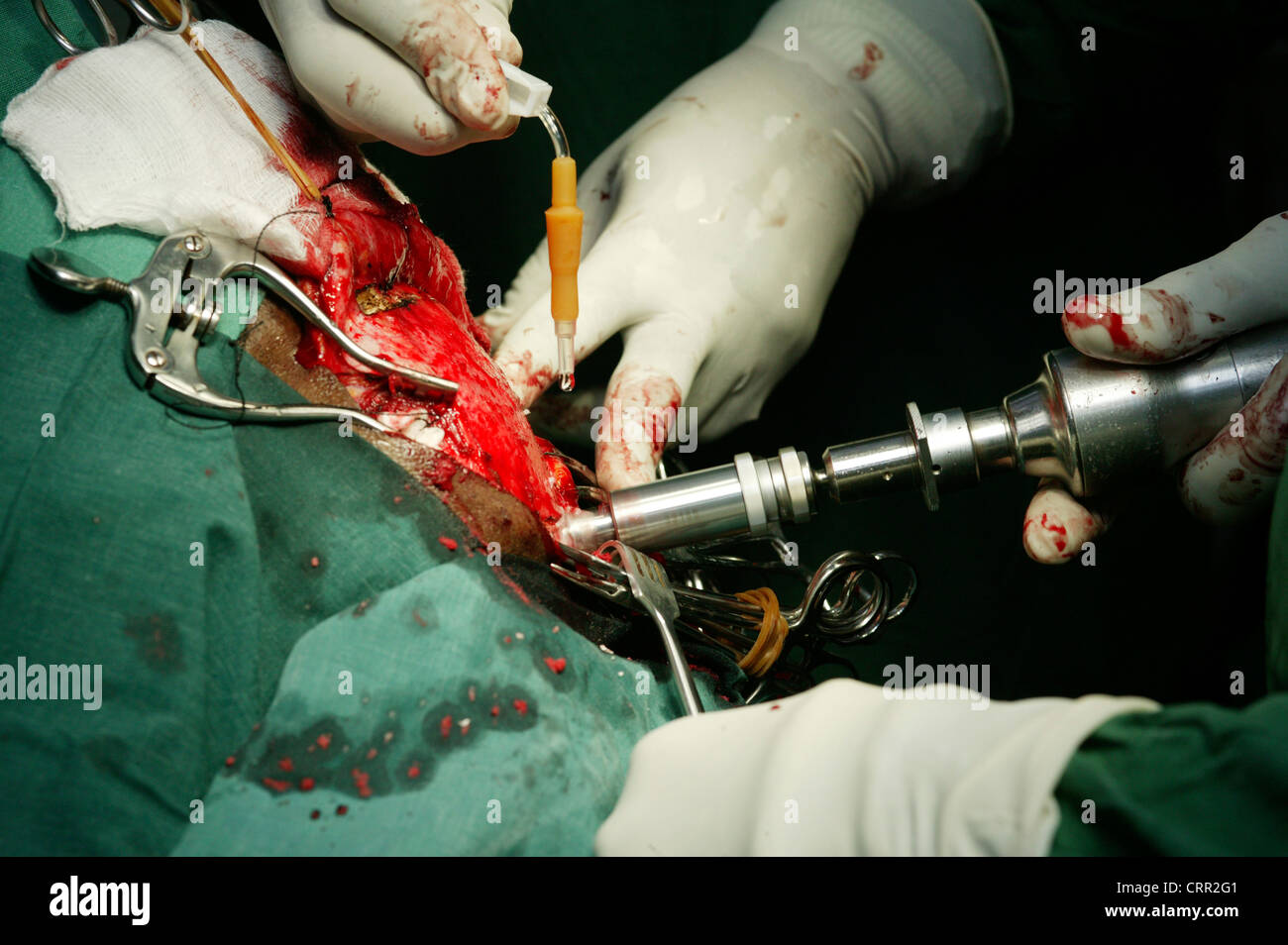 Ein High-Speed-Drill wird verwendet, um durch den Schädel, so dass der Chirurg das Gehirn während der Neurochirurgie Zugang zu durchdringen. Stockfoto