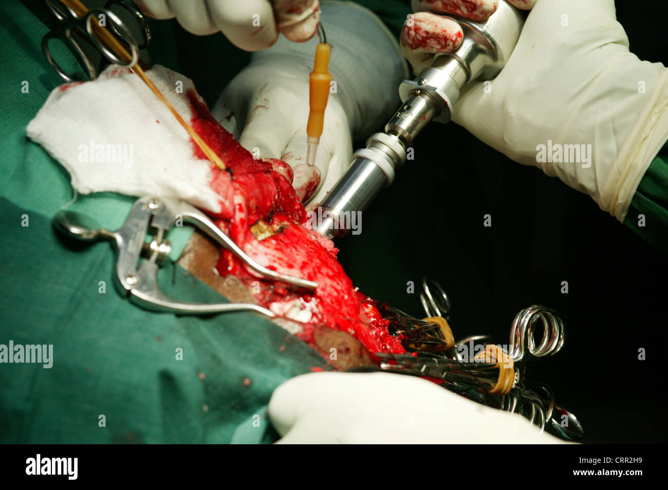 Ein High-Speed-Drill wird verwendet, um durch den Schädel, so dass der Chirurg das Gehirn während der Neurochirurgie Zugang zu durchdringen. Stockfoto