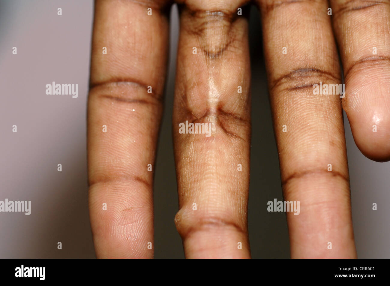 Haut Anomalien auf eine Patienten-Finger Stockfoto