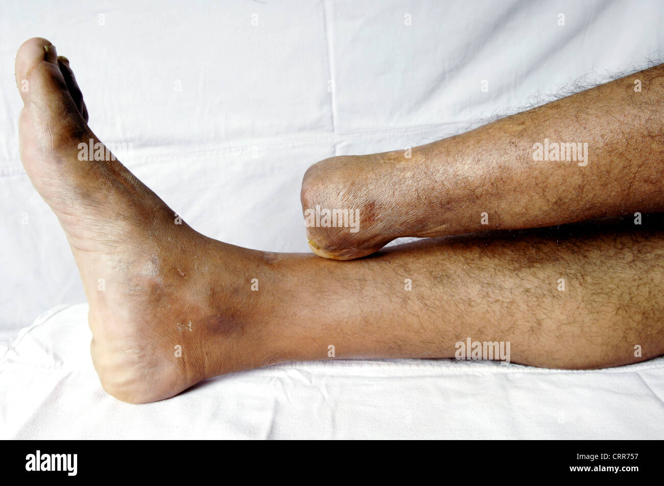 Amputierten linken Fuß Stockfoto
