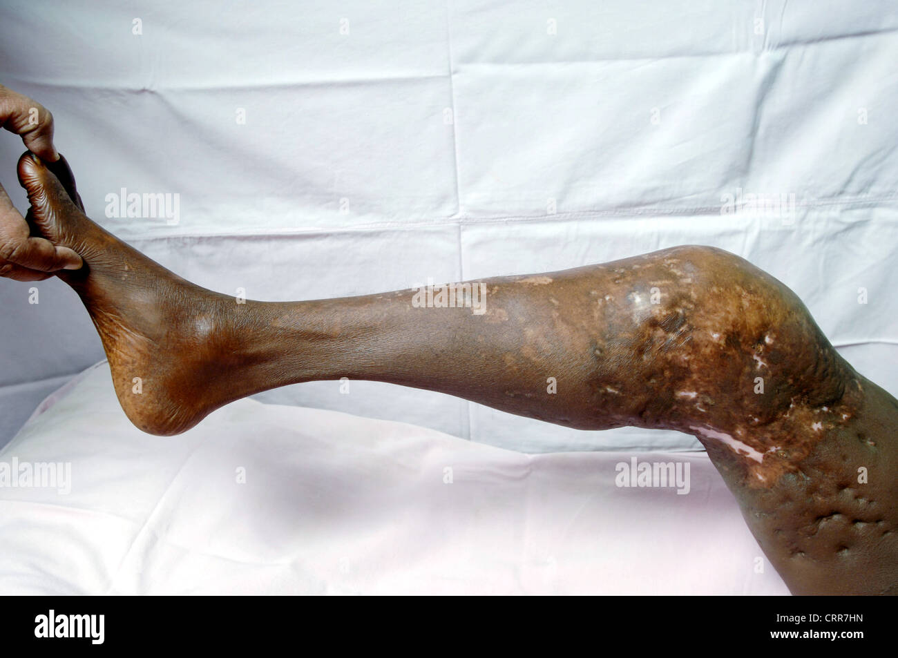 Ein Patient mit chronisch granulomatöse am Bein Stockfoto