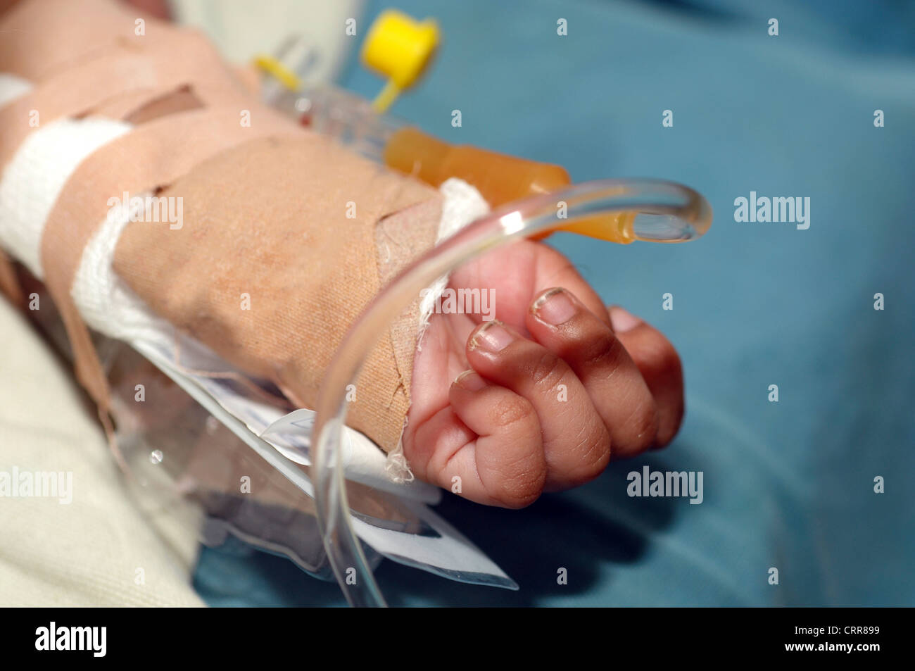 Ein Baby Arm während der Operation. Stockfoto