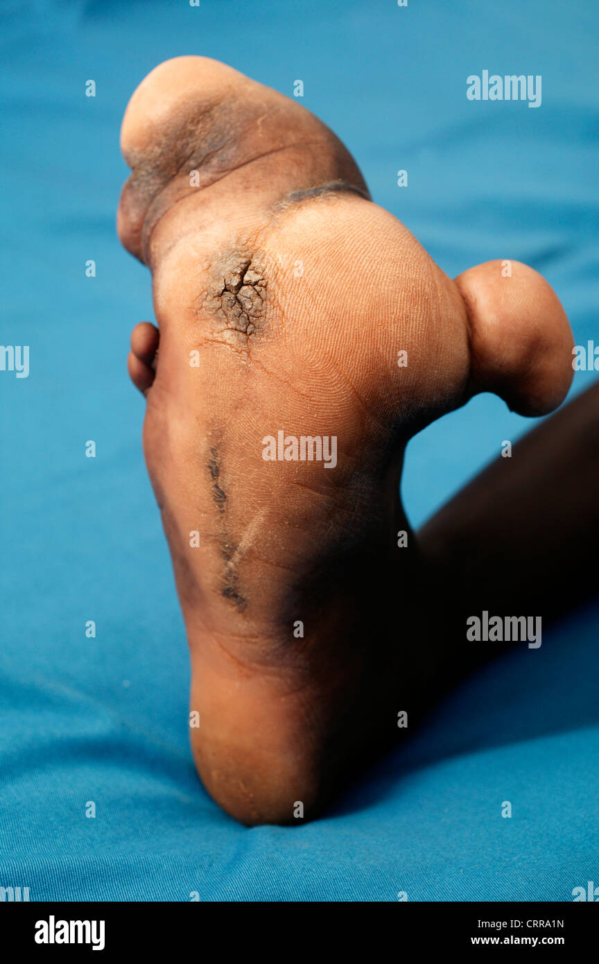 Nahaufnahme einer erweiterten rechten Fuß eines 6 Jahre alten Mädchens. Die Ursache ist unbekannt. Stockfoto