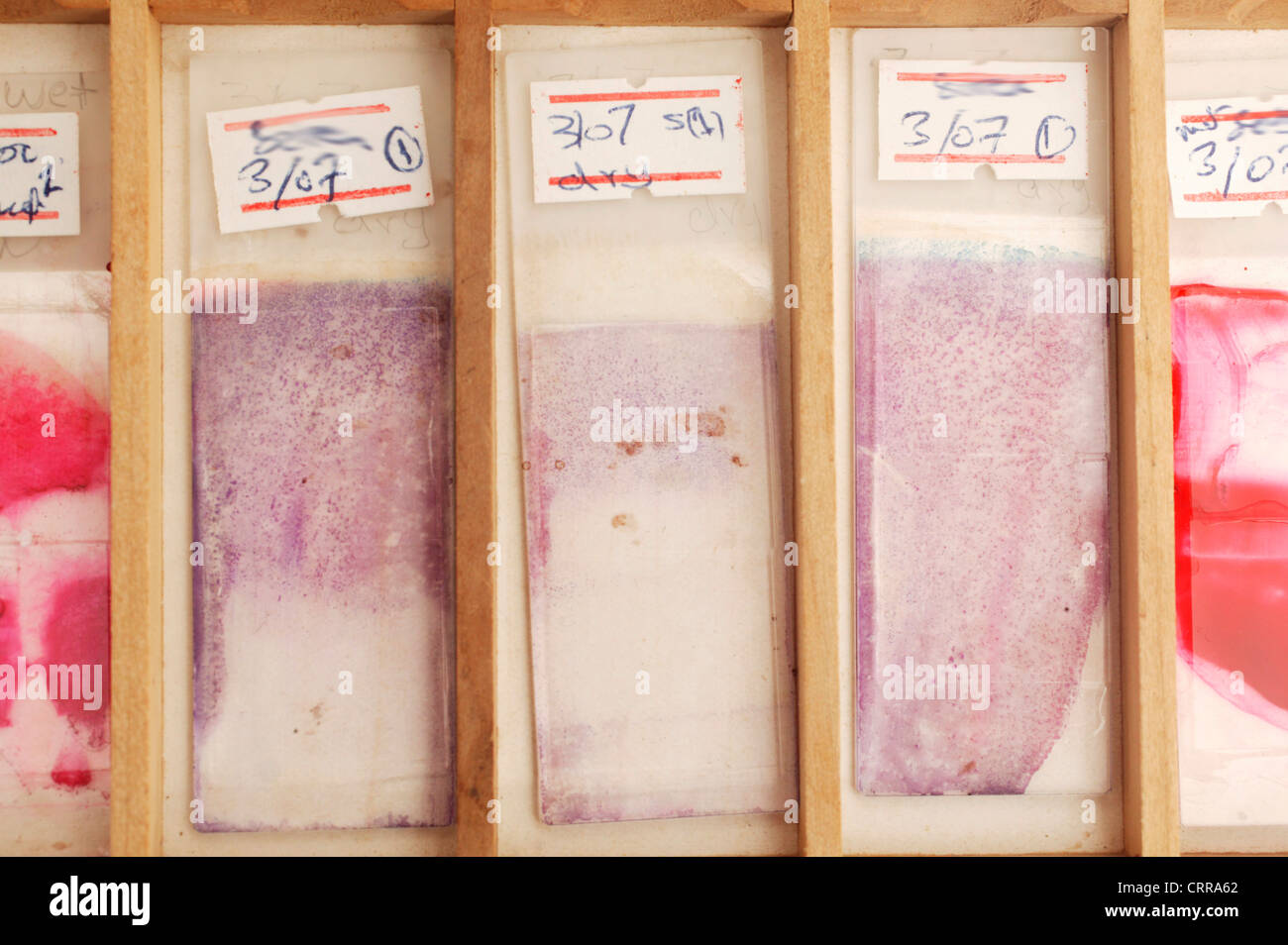 Folien der Ascites-Flüssigkeit. Stockfoto