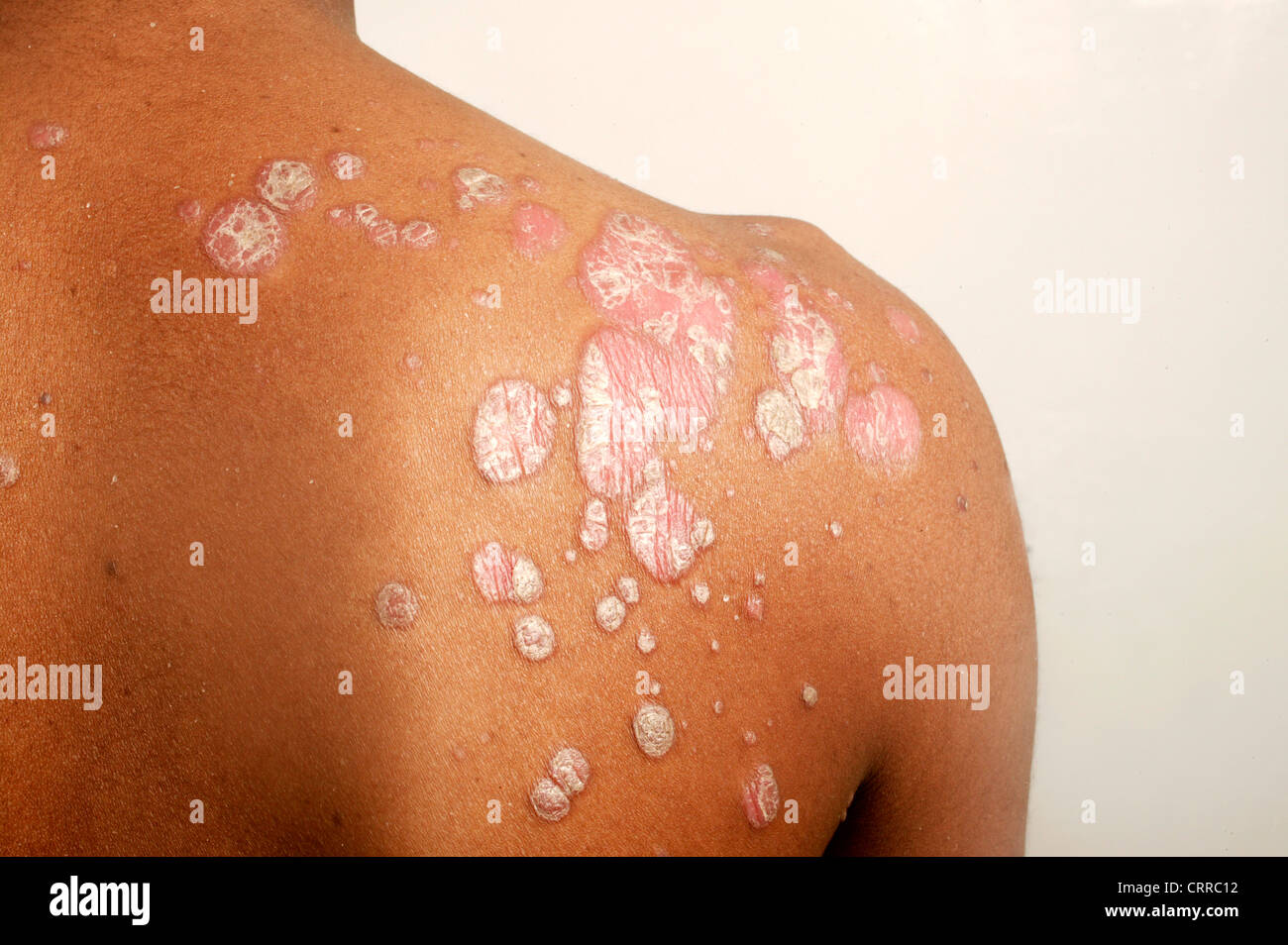 Erythrodermie auf dem Rücken eines jungen Mannes Stockfoto