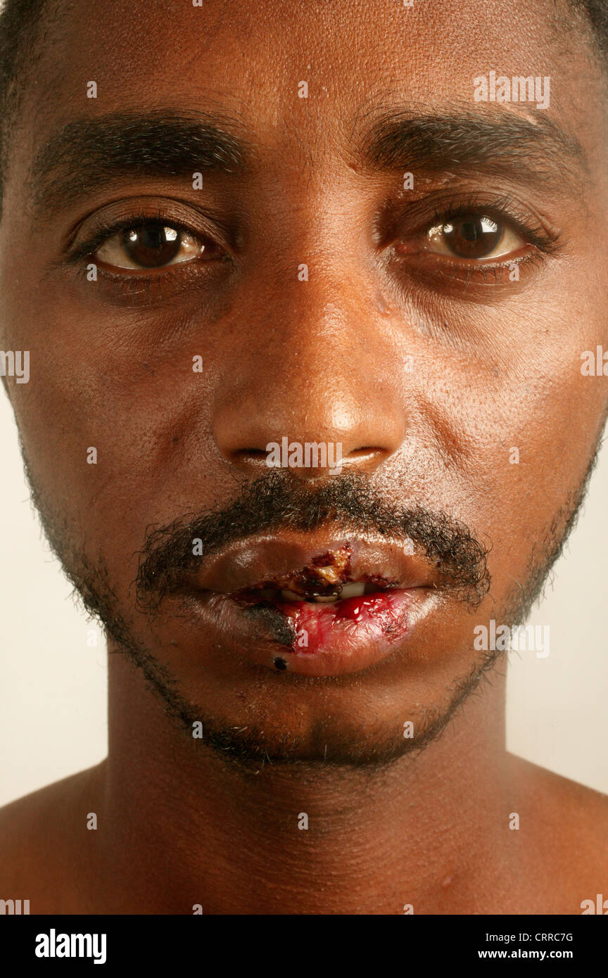 Nahaufnahme des Gesichts eines 30 Jahre alten männlichen Erythema Multiforms (Medikament Eruptionen) leiden Stockfoto