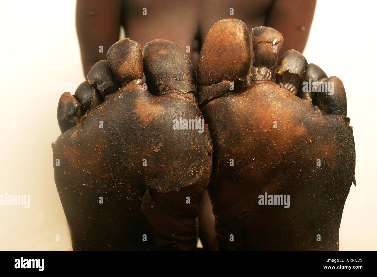 Erythroderma Auftritt an den Füßen einer 37 Jahre alten Frau, die durch weit verbreitete Schuppen auf der Haut gekennzeichnet ist. Stockfoto