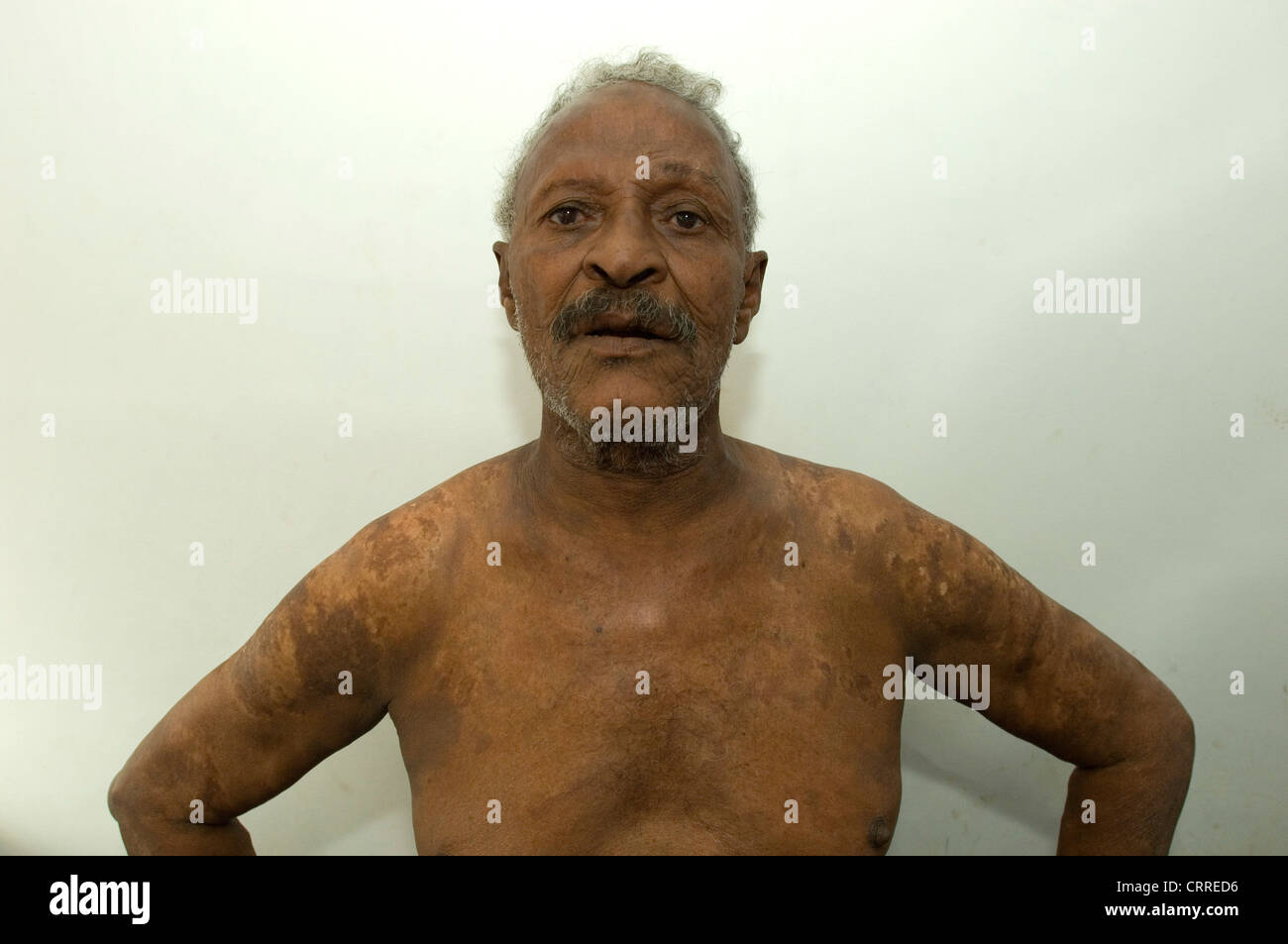 Ein älterer Mann mit einer Pilzinfektion der Haut-Krankheit. Stockfoto