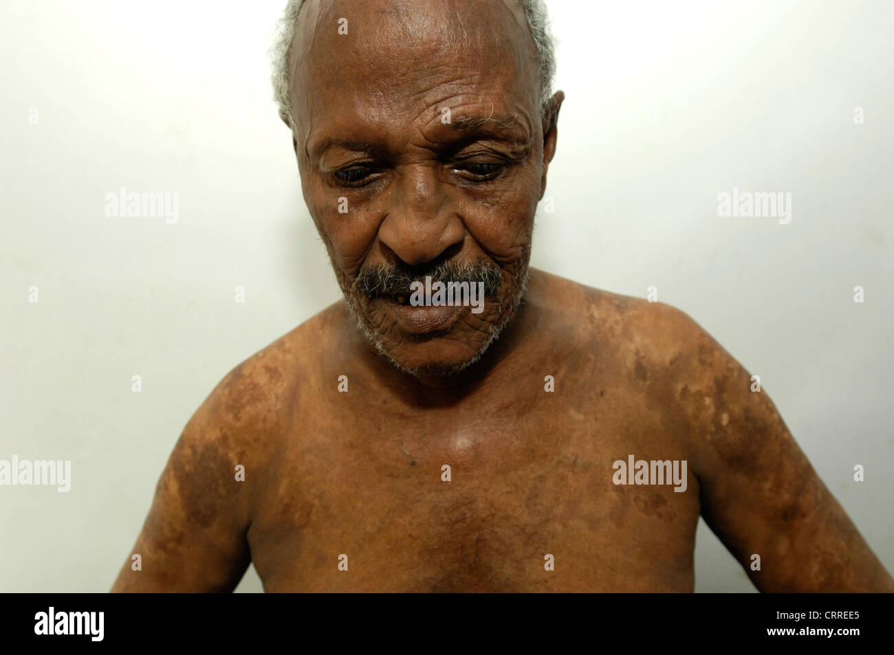 Ein älterer Mann mit einer Pilzinfektion der Haut-Krankheit. Stockfoto
