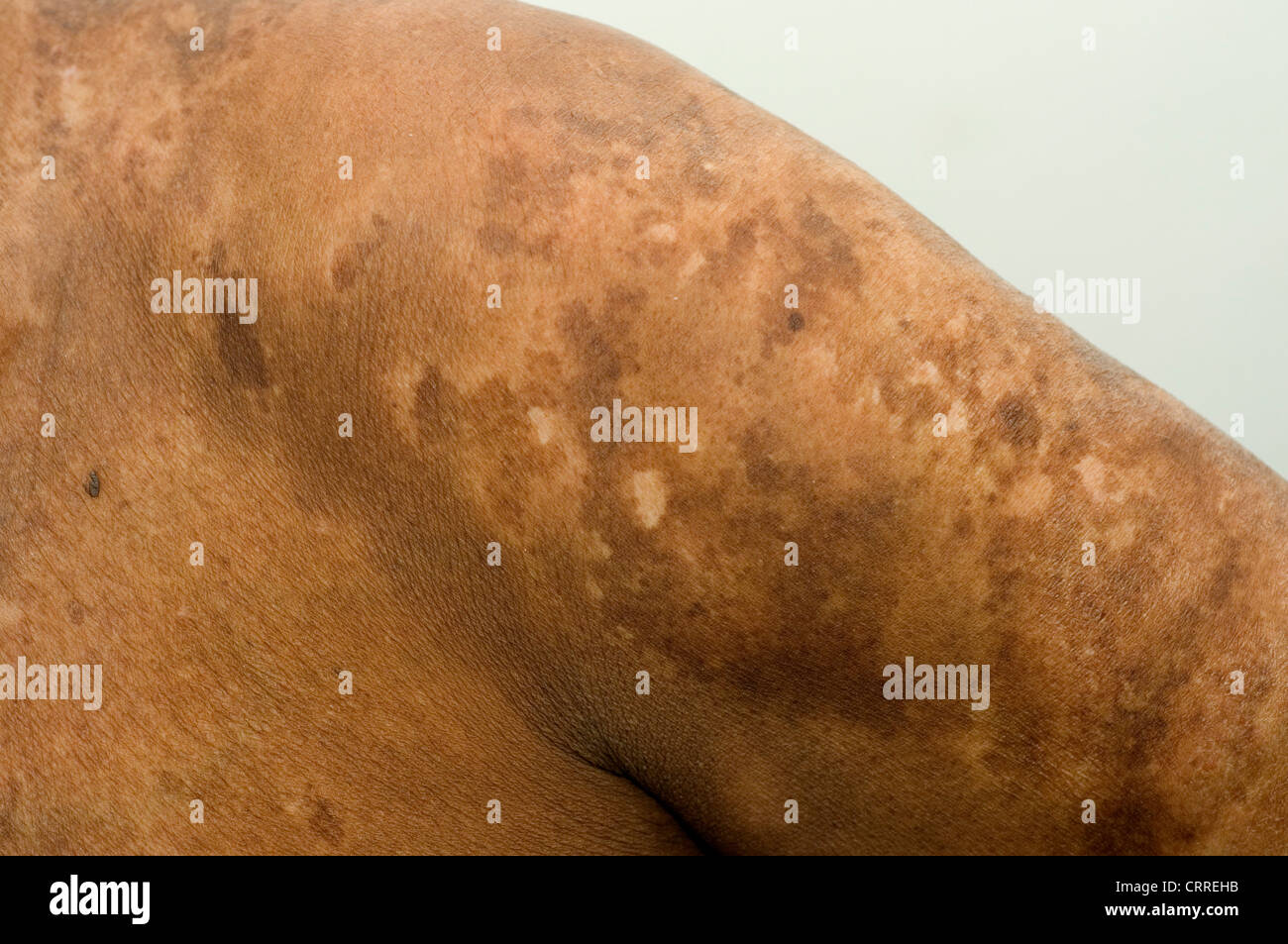 Ein Patient mit einer Pilzinfektion der Haut. Stockfoto