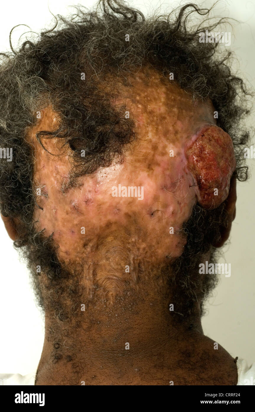 Ein Mann mit einem sebaceus Karzinom der Kopfhaut und begleitende Alopezie. Stockfoto