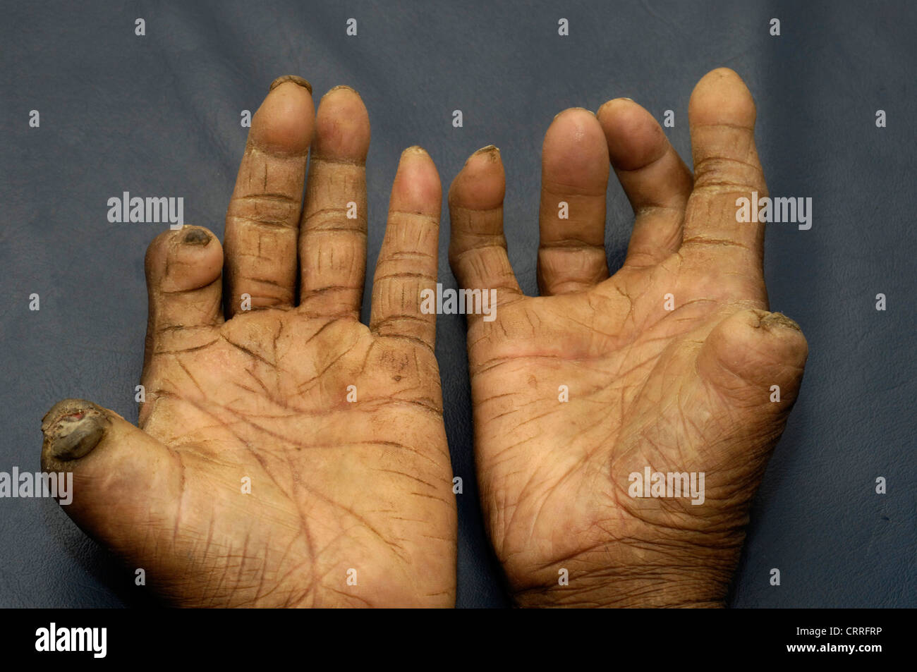 Ein Patient mit leprosy.is wahrscheinlich die Krankheit seit dreißig Jahren oder mehr haben. Stockfoto