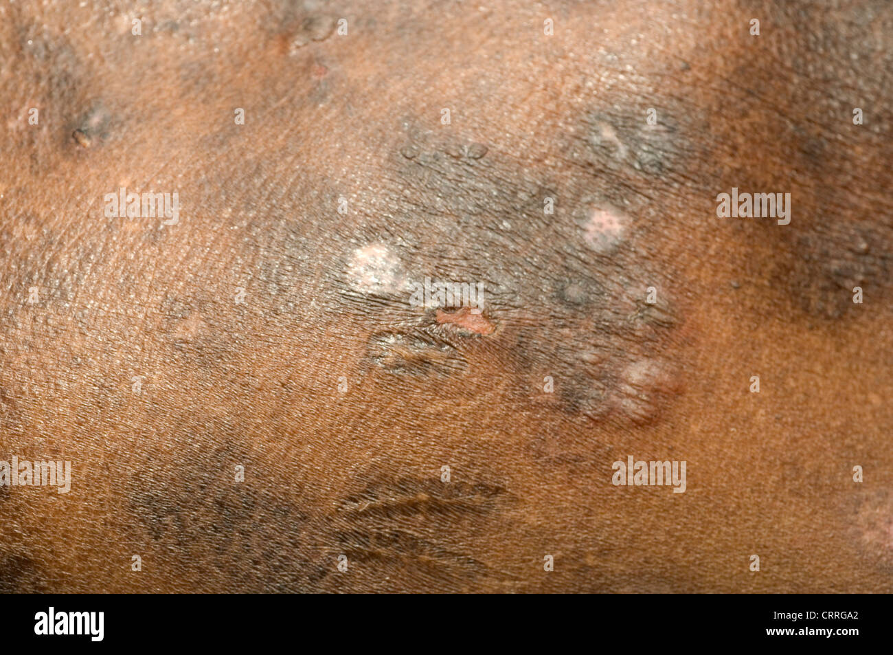 Ein Mann mit einer Pilzinfektion der Haut-Krankheit Stockfoto