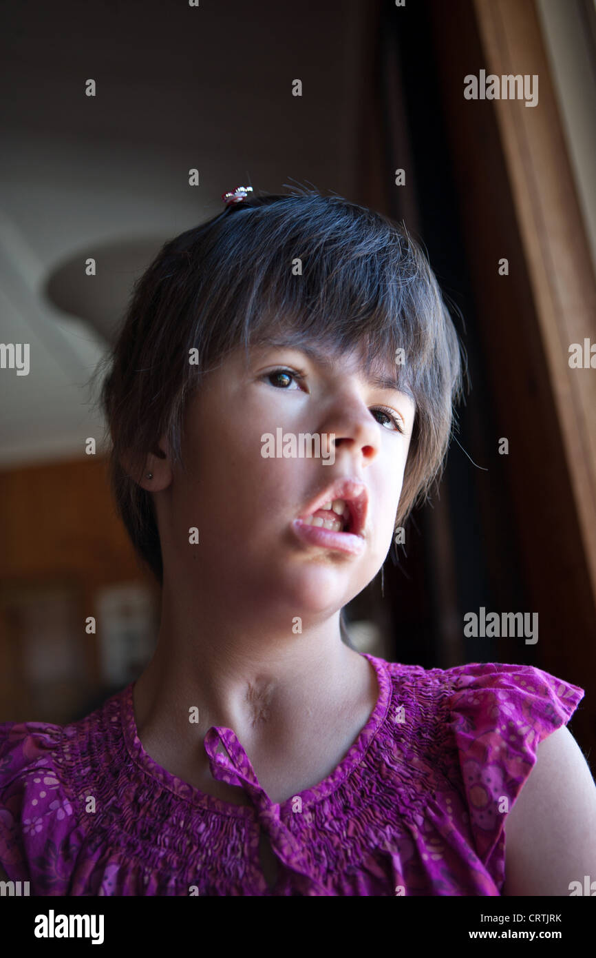 Sieben Jahre altes Mädchen mit myotonische Muskeldystrophie Blick aus Fenster zu Hause. Stockfoto