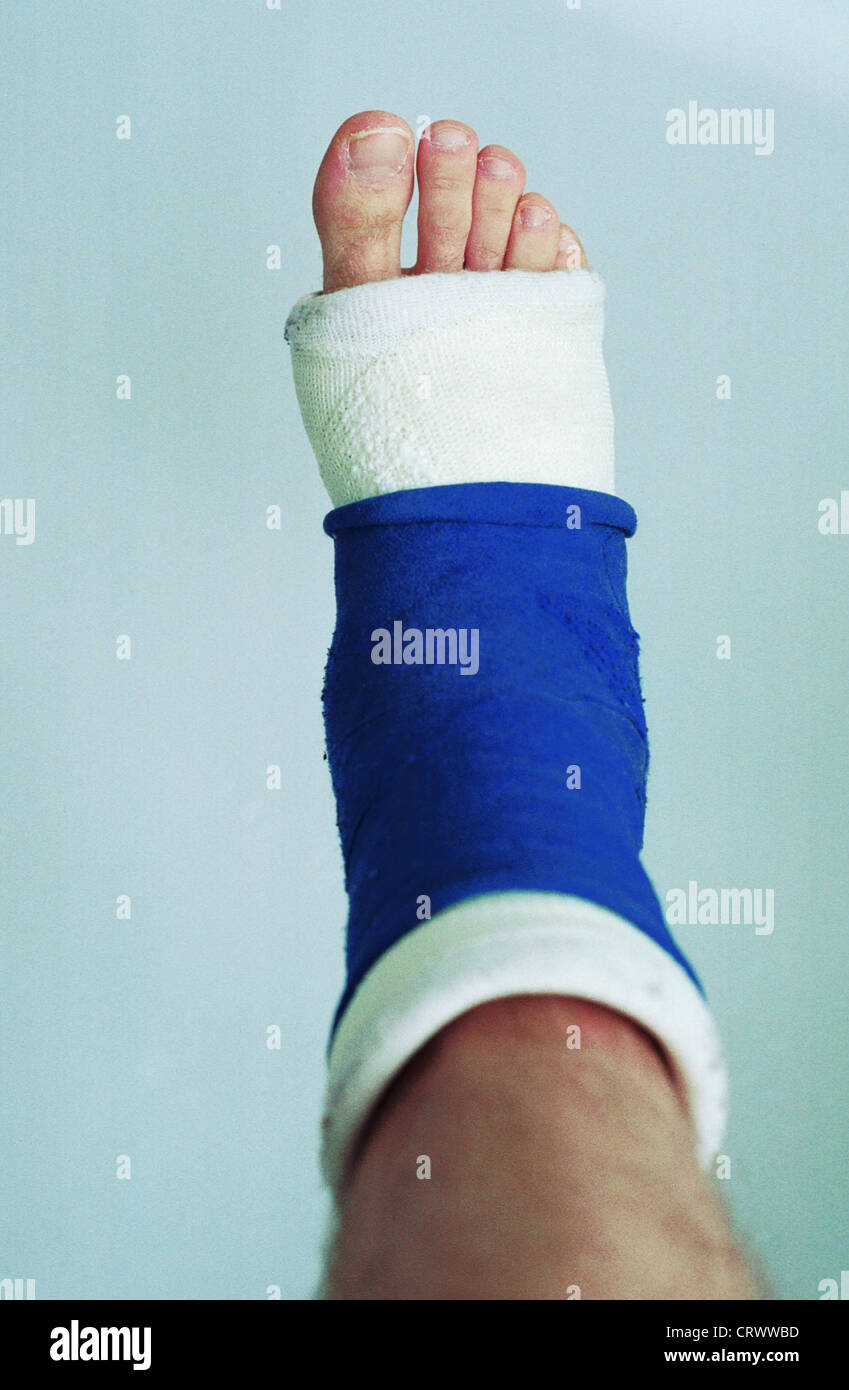Einen gebrochenen Fuß in Gips Stockfotografie Alamy