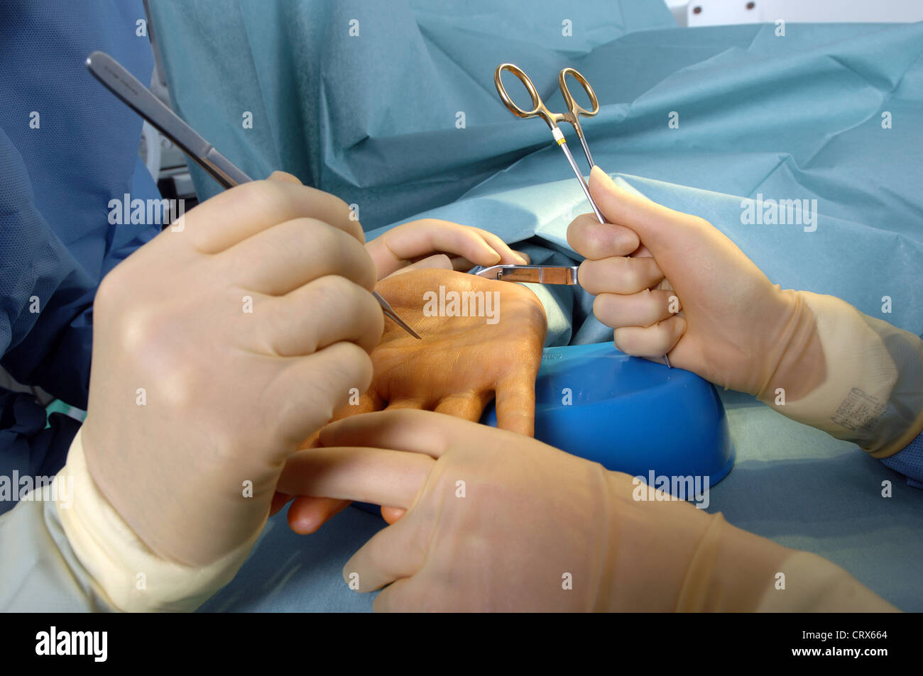 Ein Chirurg, Vorbereitung auf einen Patienten Hand betreiben. Stockfoto