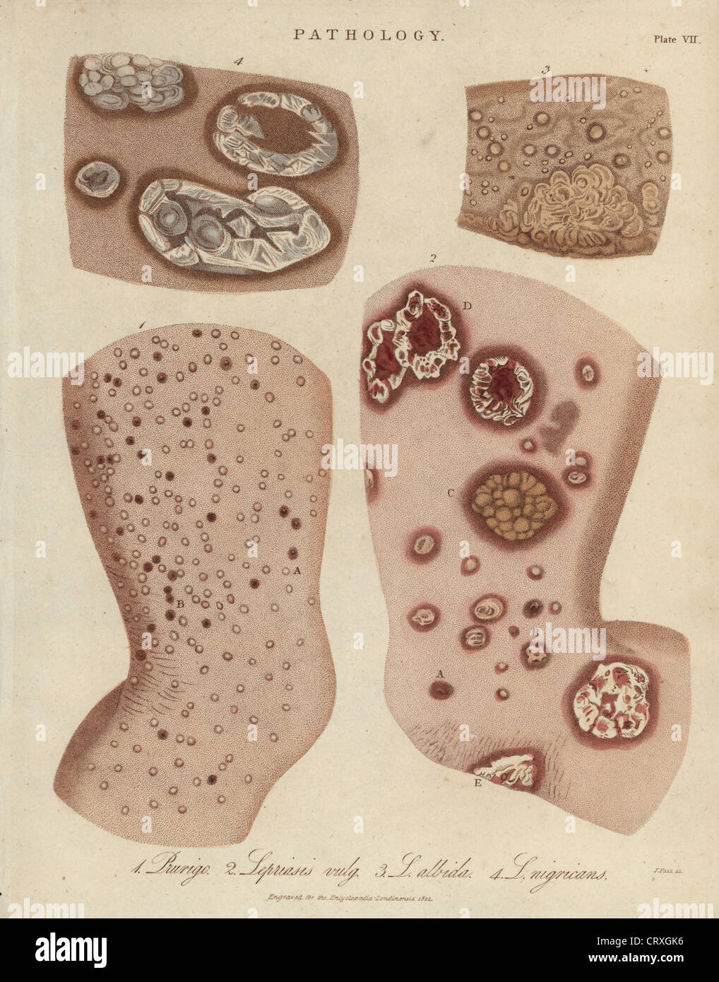 Hautkrankheiten: Prurigo Nodularis und Psoriasis Sorten. Stockfoto