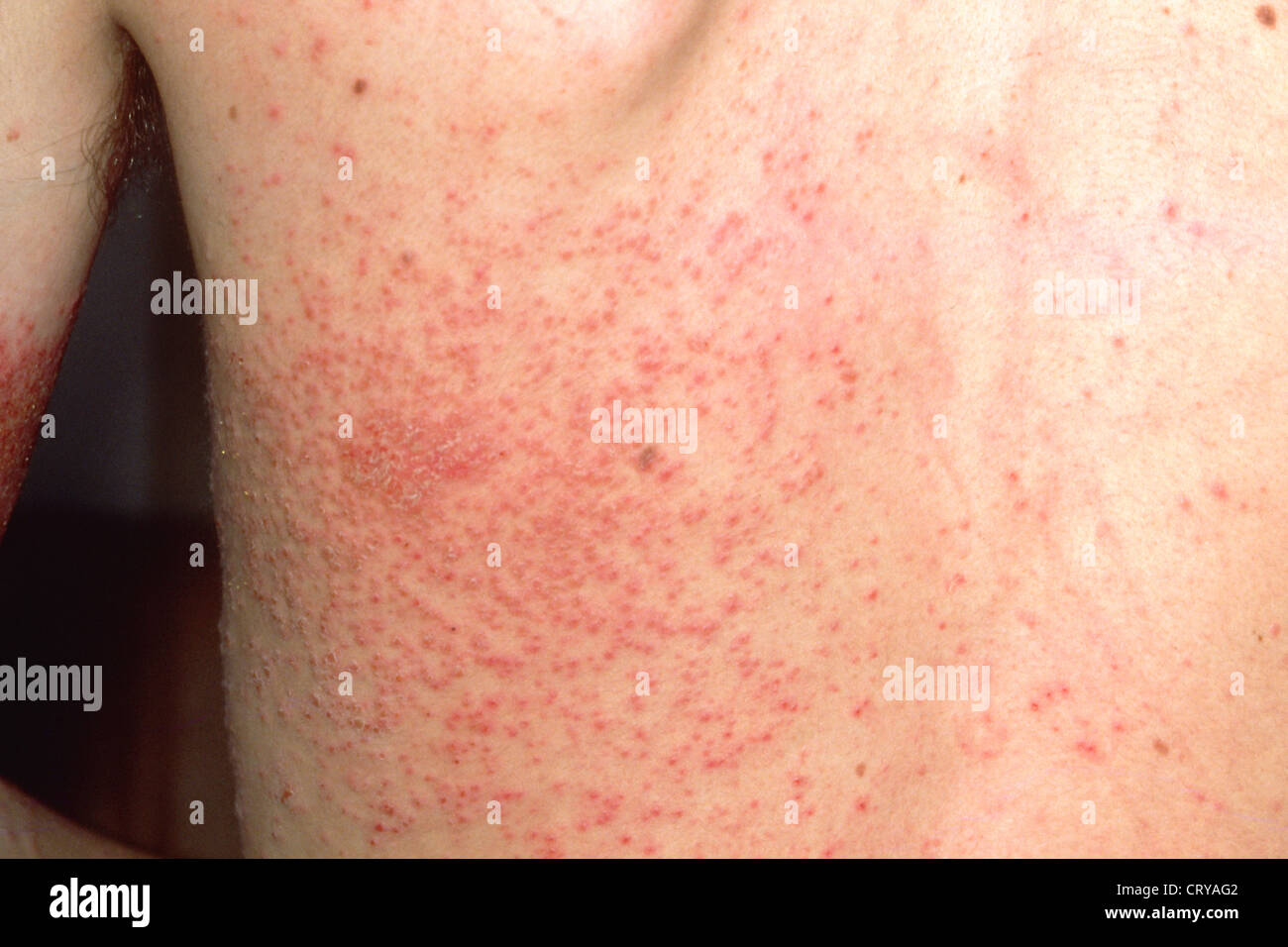 KONTAKTDERMATITIS. Stockfoto