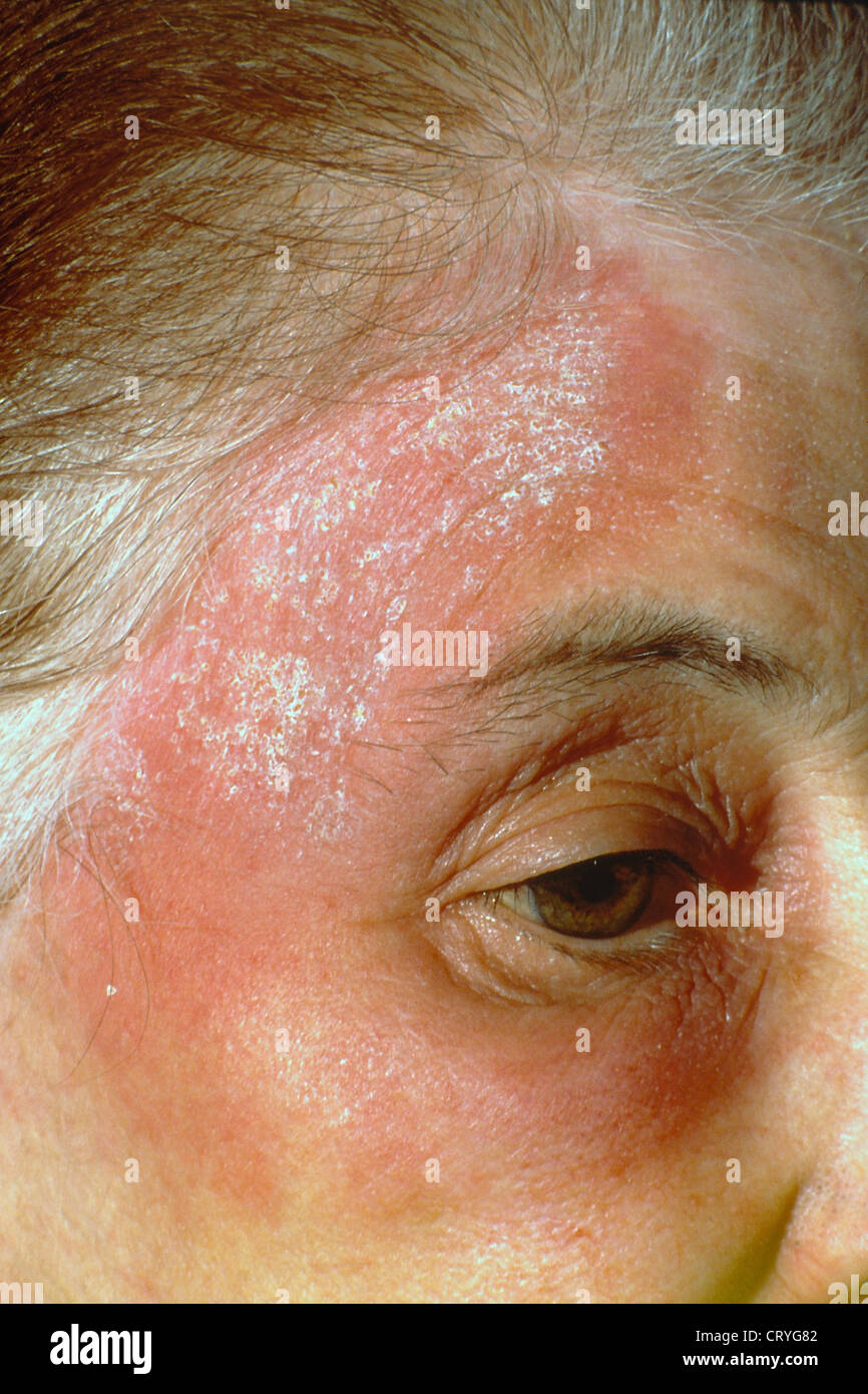 KONTAKTDERMATITIS. Stockfoto